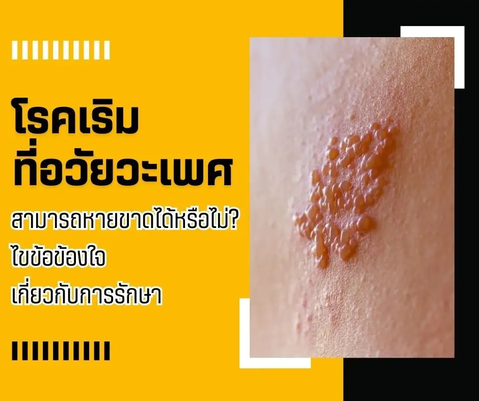 โรคเริมที่อวัยวะเพศ สามารถหายขาดได้หรือไม่? ไขข้อข้องใจเกี่ยวกับการรักษา