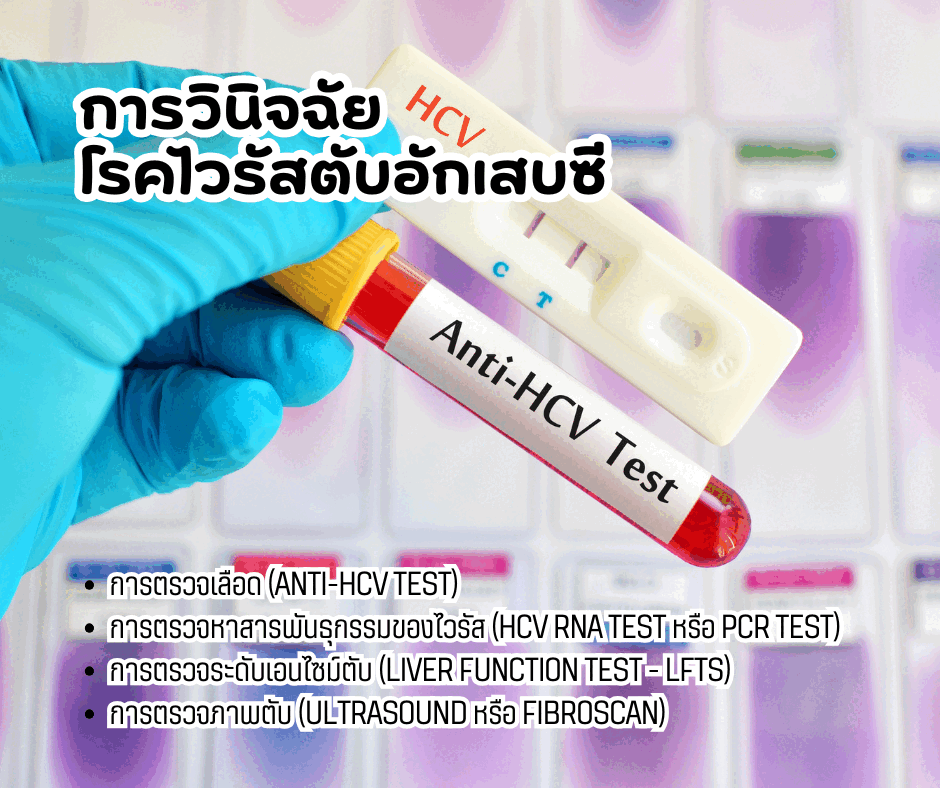 2.การวินิจฉัยโรคไวรัสตับอักเสบซี