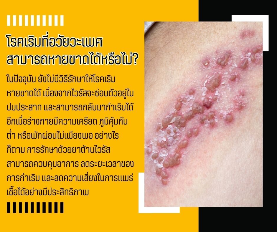 โรคเริมที่อวัยวะเพศ สามารถหายขาดได้หรือไม่
