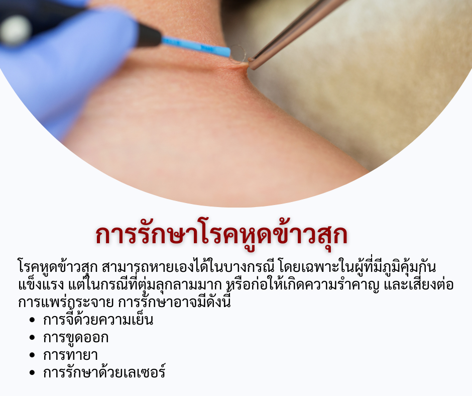 การรักษา โรคหูดข้าวสุก