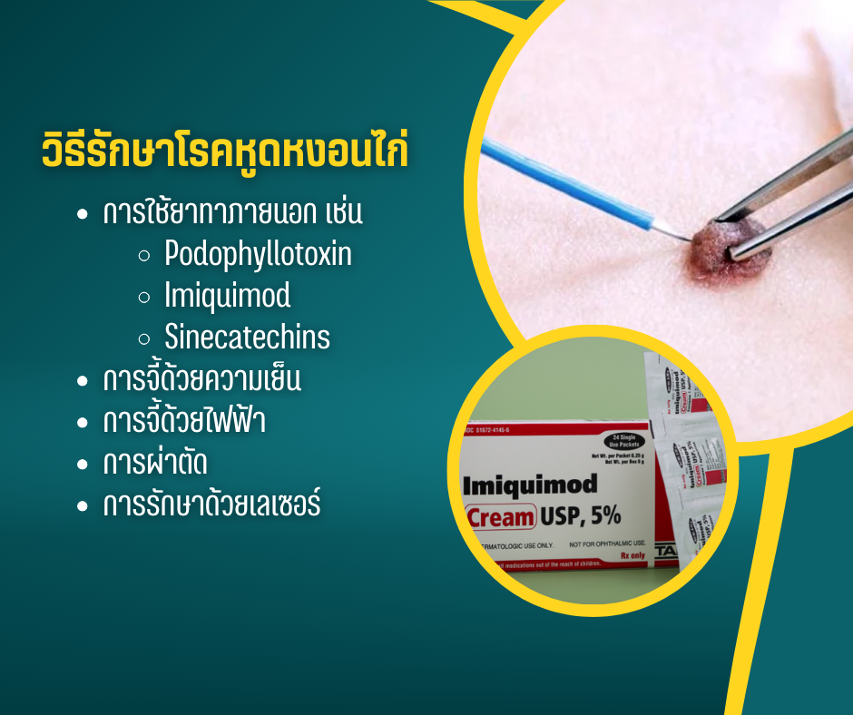 วิธีรักษาโรคหูดหงอนไก่